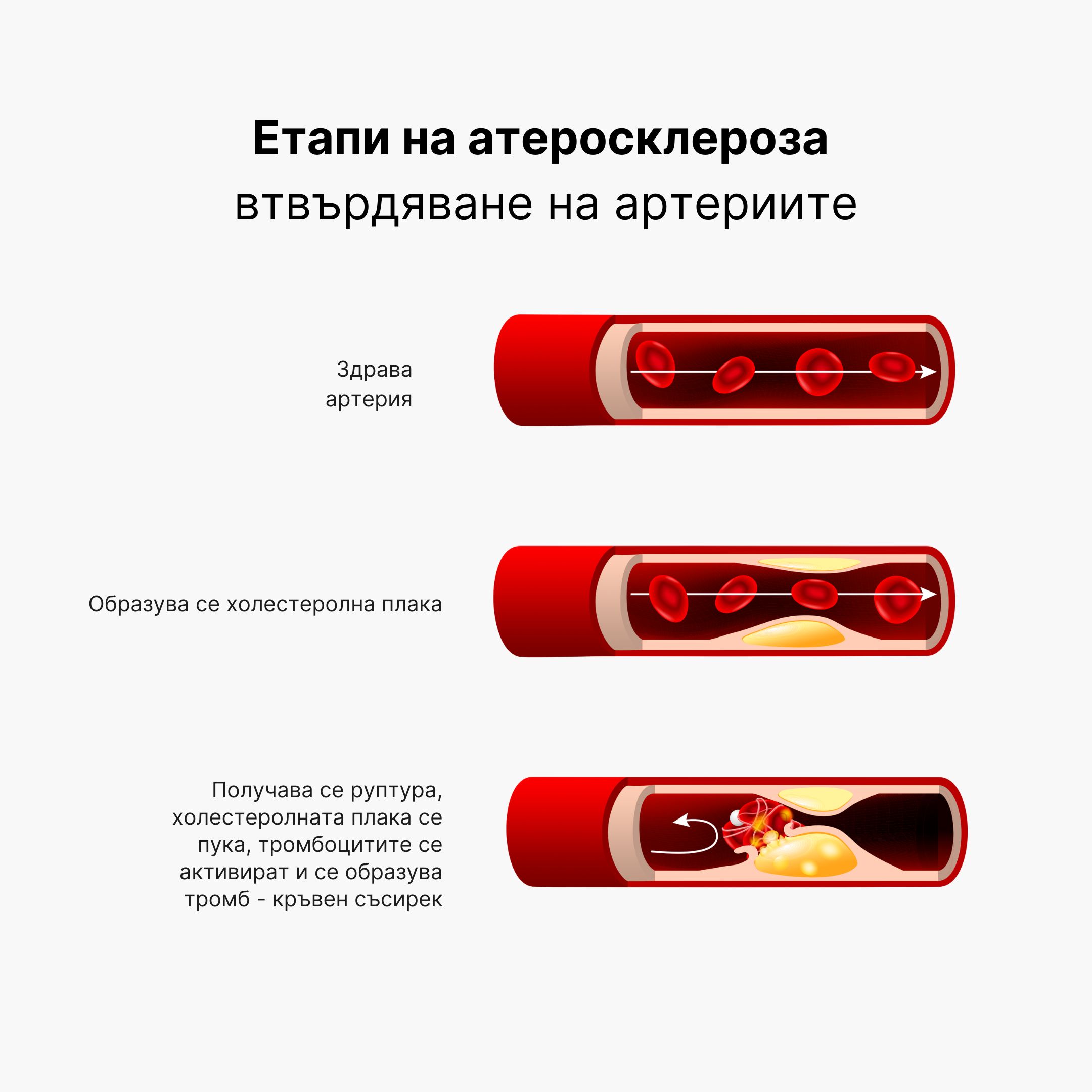 (Bulharština) Arterioskleróza